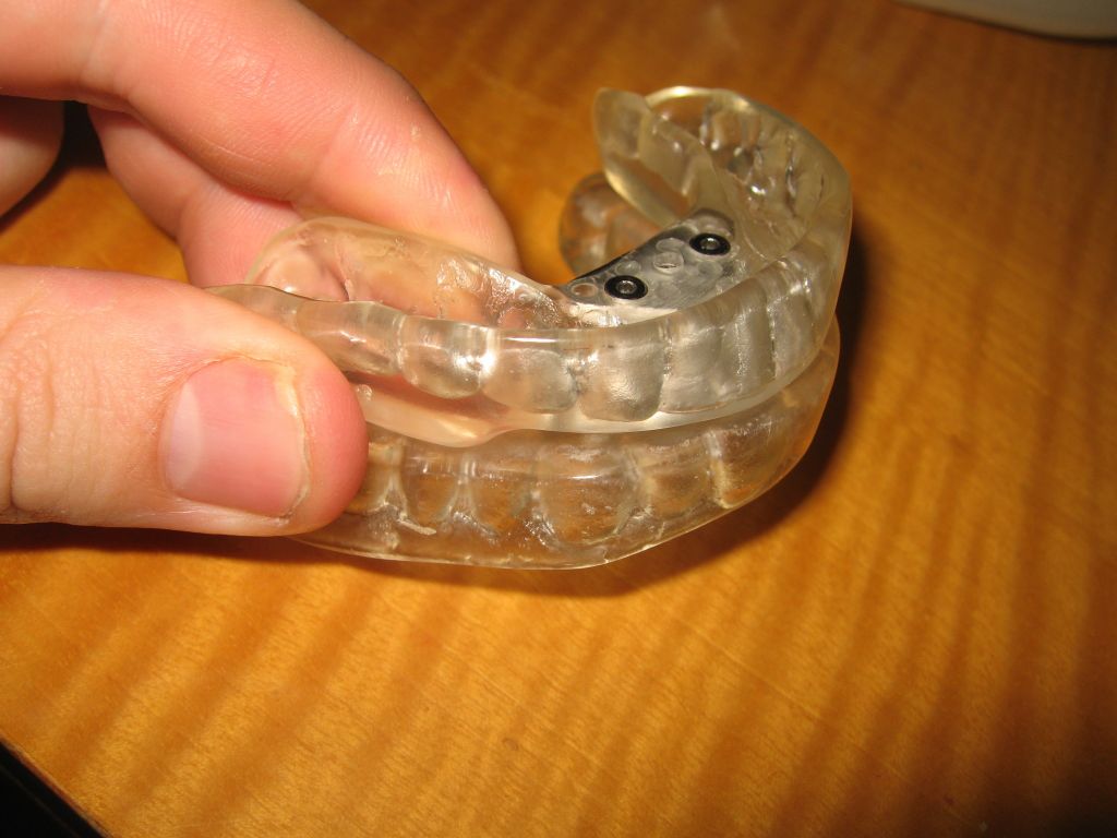 this forces my bottom jaw forward when I sleep and opens my airway better, helping sleep apnea