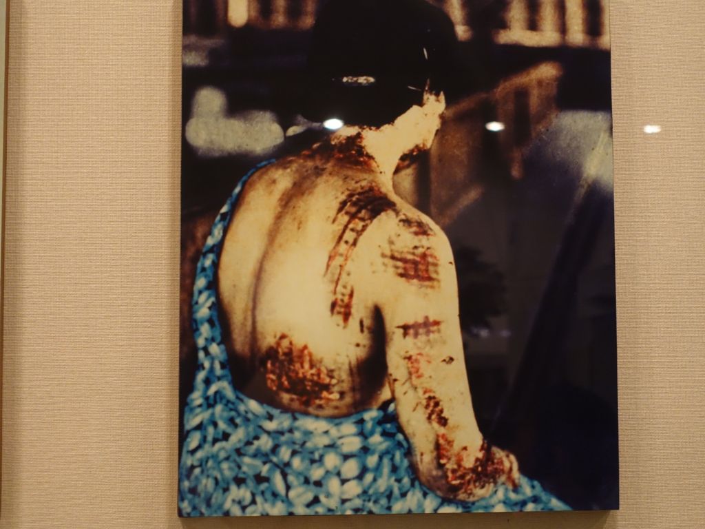 this poor lady got her kimono patterns burnt into her skin
