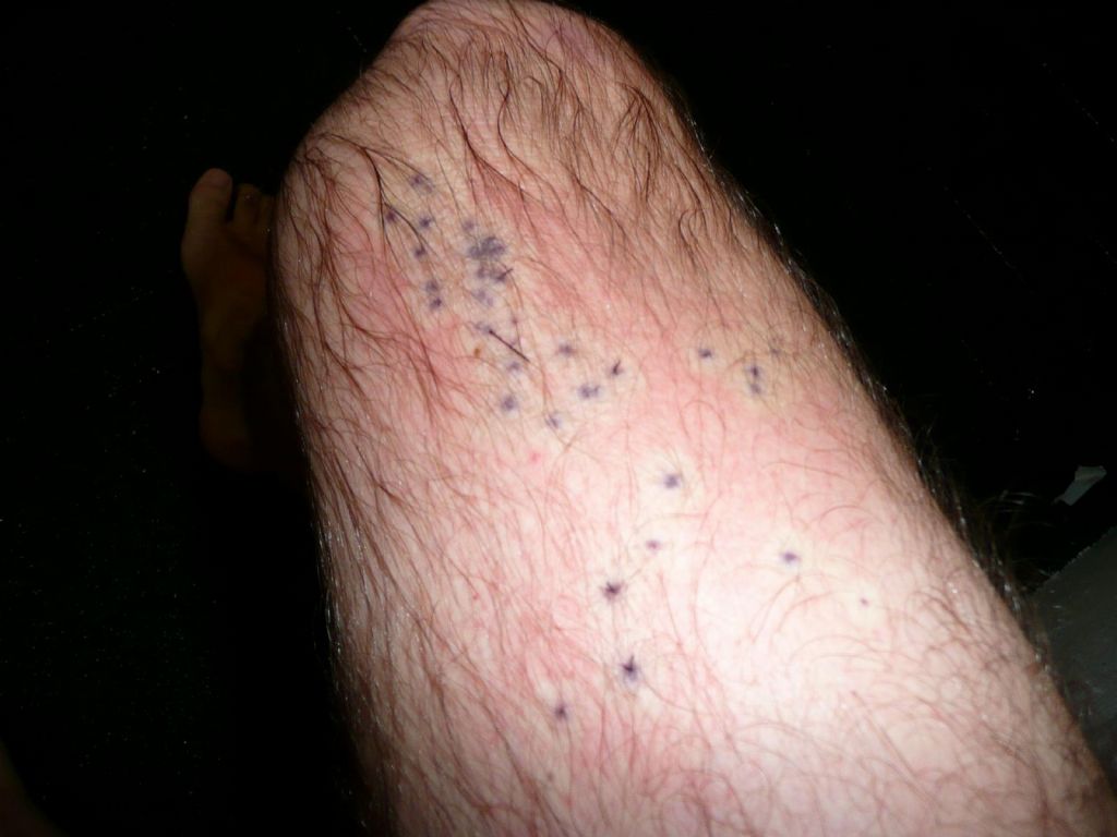 20 sea urchin spikes in my leg, that did hurt like a bitch